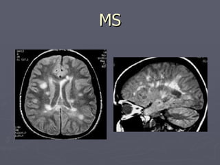 MS 