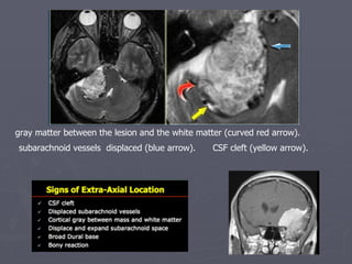 gray matter between the lesion and the white matter (curved red arrow).  subarachnoid vessels  displaced (blue arrow).  CS...