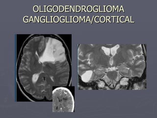 OLIGODENDROGLIOMA GANGLIOGLIOMA/CORTICAL 