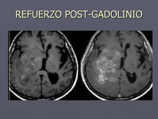 REFUERZO POST-GADOLINIO 