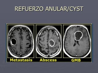 REFUERZO ANULAR/CYST 
