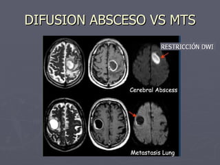 DIFUSION ABSCESO VS MTS 