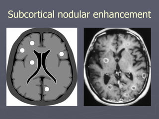 Subcortical nodular enhancement 