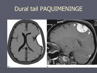Dural tail PAQUIMENINGE 