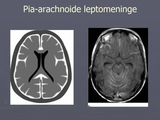 Pia-arachnoide leptomeninge 