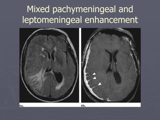 Mixed pachymeningeal and leptomeningeal enhancement 