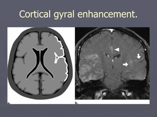 Cortical gyral enhancement. 