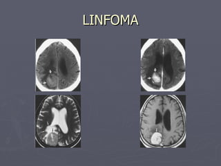 LINFOMA 