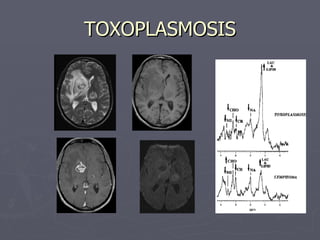 TOXOPLASMOSIS 