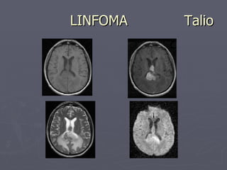 LINFOMA  Talio 