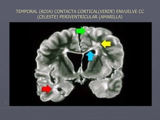 TEMPORAL (ROJA) CONTACTA CORTICAL(VERDE) ENVUELVE CC (CELESTE) PERIVENTRICULAR (AMARILLA) 