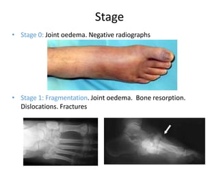 • Stage 0: Joint oedema. Negative radiographs
• Stage 1: Fragmentation. Joint oedema. Bone resorption.
Dislocations. Fractures
Stage
 