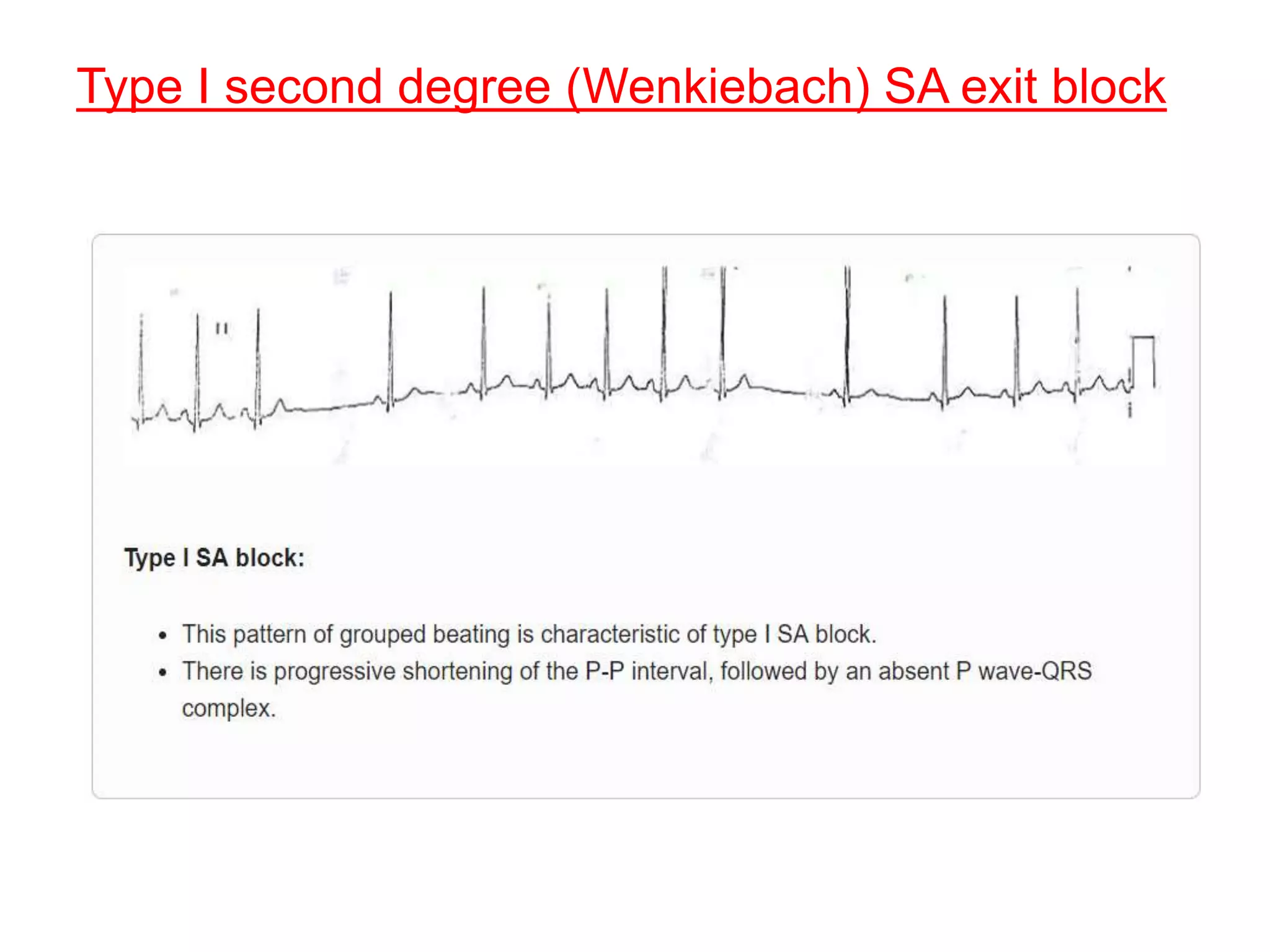 Type I second degree (Wenkiebach) SA exit block
 