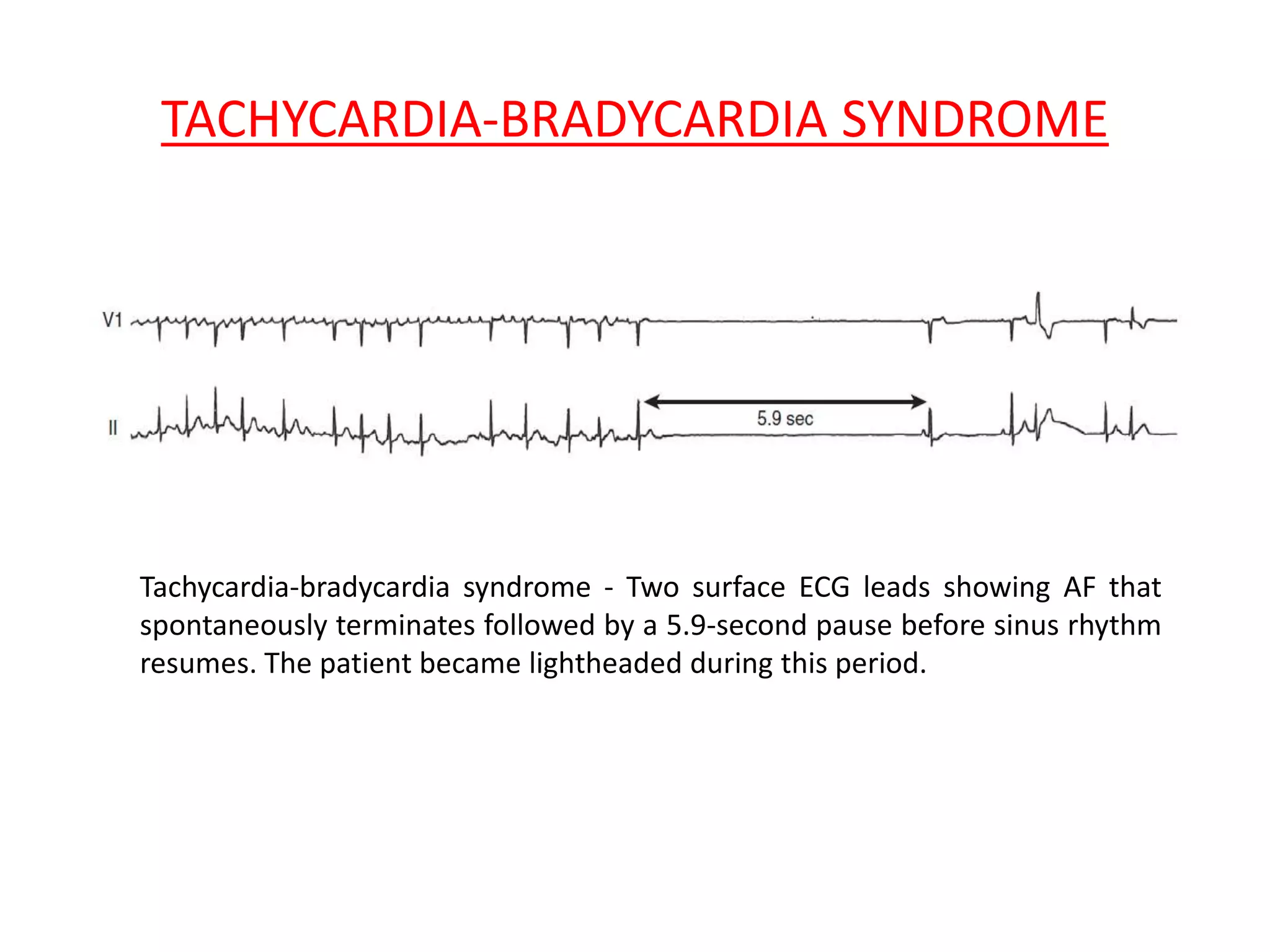 TACHYCARDIA-BRADYCARDIA SYNDROME
Tachycardia-bradycardia syndrome - Two surface ECG leads showing AF that
spontaneously terminates followed by a 5.9-second pause before sinus rhythm
resumes. The patient became lightheaded during this period.
 
