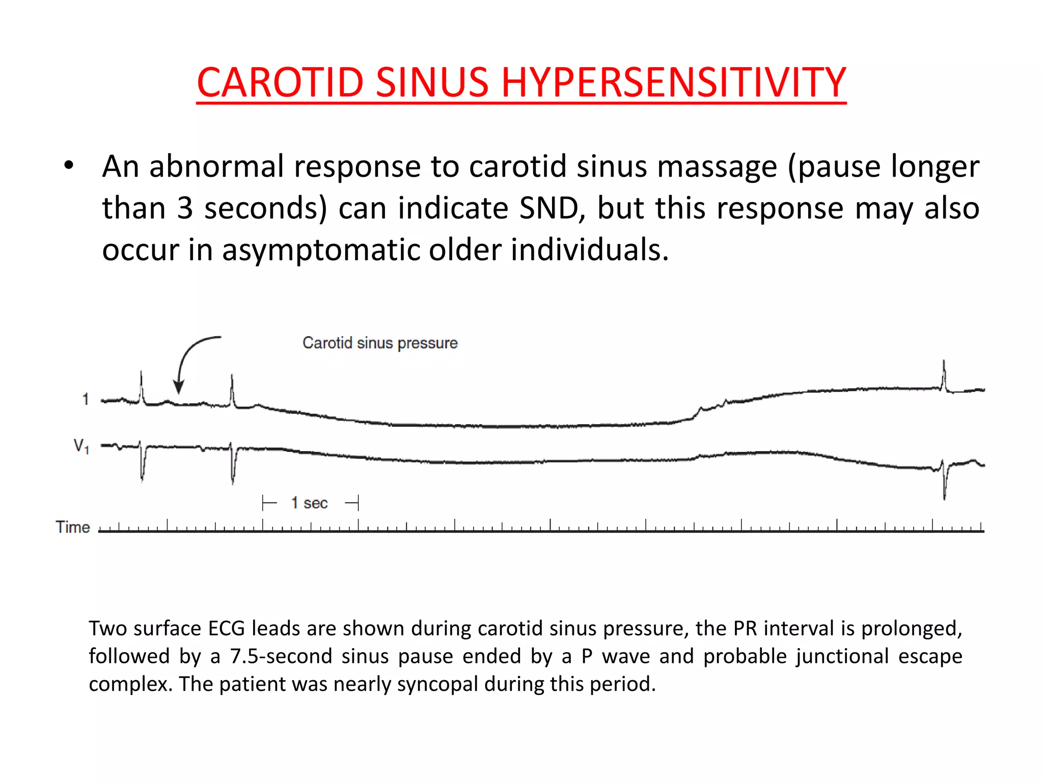 CAROTID SINUS HYPERSENSITIVITY
• An abnormal response to carotid sinus massage (pause longer
than 3 seconds) can indicate SND, but this response may also
occur in asymptomatic older individuals.
Two surface ECG leads are shown during carotid sinus pressure, the PR interval is prolonged,
followed by a 7.5-second sinus pause ended by a P wave and probable junctional escape
complex. The patient was nearly syncopal during this period.
 