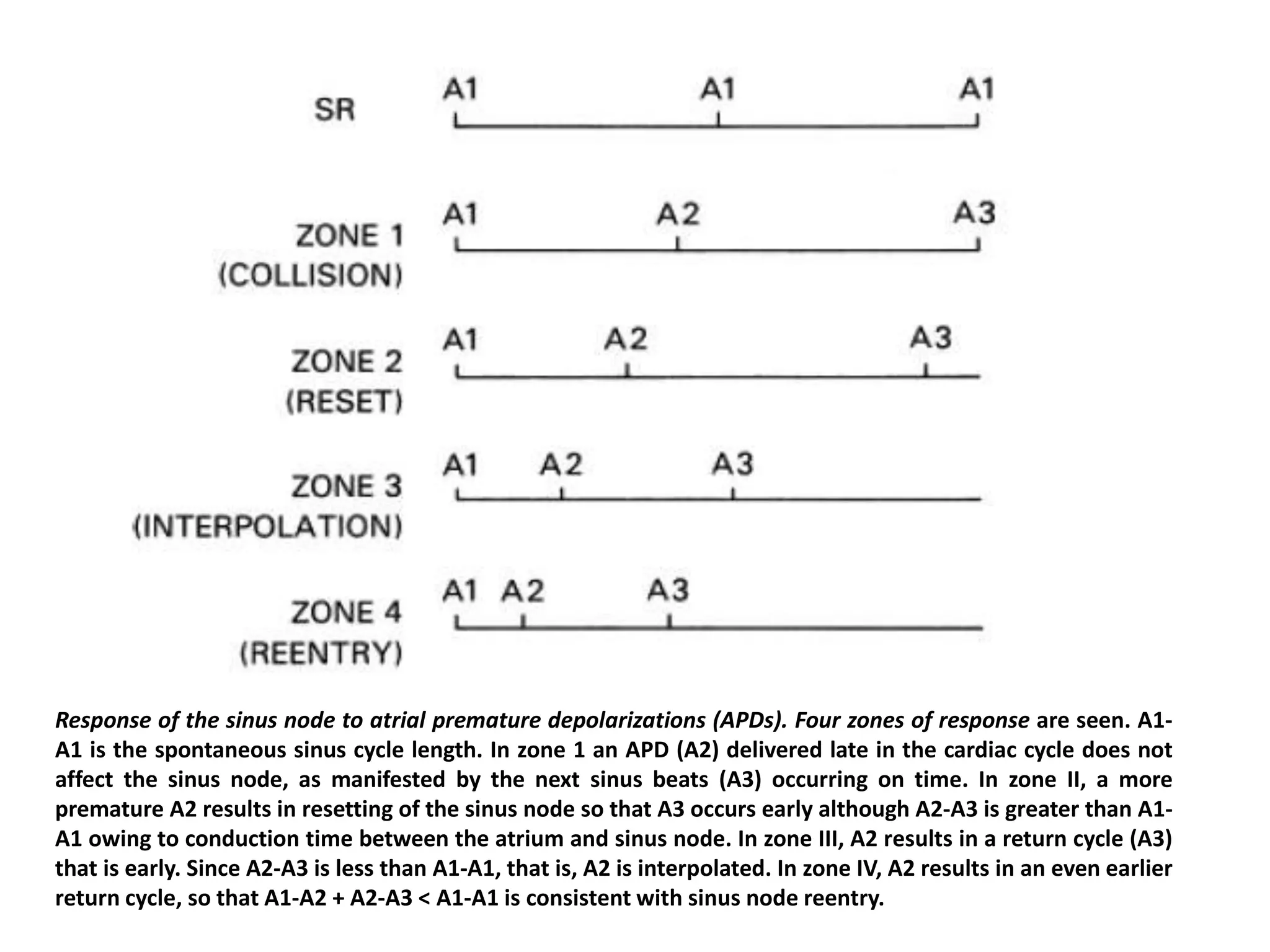 Response of the sinus node to atrial premature depolarizations (APDs). Four zones of response are seen. A1-
A1 is the spontaneous sinus cycle length. In zone 1 an APD (A2) delivered late in the cardiac cycle does not
affect the sinus node, as manifested by the next sinus beats (A3) occurring on time. In zone II, a more
premature A2 results in resetting of the sinus node so that A3 occurs early although A2-A3 is greater than A1-
A1 owing to conduction time between the atrium and sinus node. In zone III, A2 results in a return cycle (A3)
that is early. Since A2-A3 is less than A1-A1, that is, A2 is interpolated. In zone IV, A2 results in an even earlier
return cycle, so that A1-A2 + A2-A3 < A1-A1 is consistent with sinus node reentry.
 