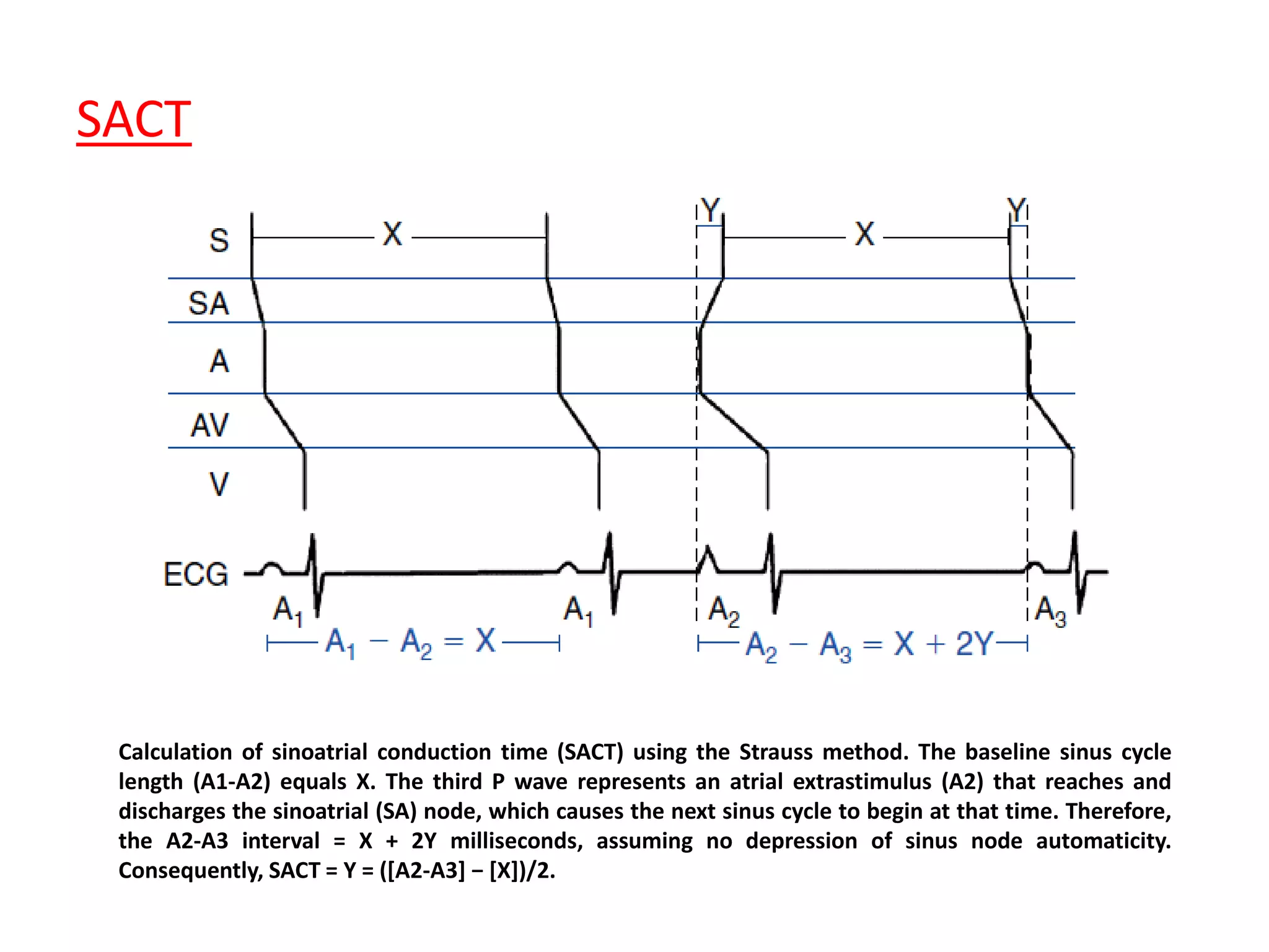 SACT
Calculation of sinoatrial conduction time (SACT) using the Strauss method. The baseline sinus cycle
length (A1-A2) equals X. The third P wave represents an atrial extrastimulus (A2) that reaches and
discharges the sinoatrial (SA) node, which causes the next sinus cycle to begin at that time. Therefore,
the A2-A3 interval = X + 2Y milliseconds, assuming no depression of sinus node automaticity.
Consequently, SACT = Y = ([A2-A3] − [X])/2.
 