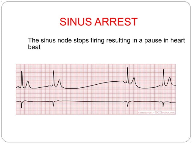 Sinus Node Dysfunction Example Sinus Node Dysfunction | PPTX