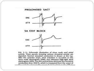 Sinus Node Dysfunction Example Sinus Node Dysfunction | PPTX
