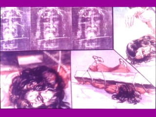 Huellas en la SS: a- En la nuca : es donde vemos sangre. Ello es lógico porque la cabeza golpeaba contra el madero, durante la permanencia en la cruz. Se ven regueros de sangre de forma irregular, que se paran a cierta altura, a causa del junco que en forma de vincha sujetaba las espinas  