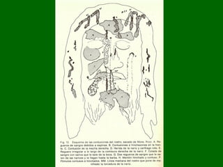 Comienza con el pinchazo en lo alto, cerca del nacimiento del cabello, y corre hacia la ceja izquierda, formando una epsilon.  