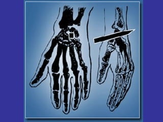 De todas maneras, más allá de las causas físicas, debemos recordar que NS ha muerto por su voluntad soberana:  “Cuando hubo tomado vinagre, dijo: ‘Está cumplido’, e inclinando la cabeza, entregó el espíritu” (Jn.19,30) “ Yo pongo mi vida para volverla a tomar. Nadie me la puede quitar, sino que Yo mismo la pongo” (Jn.10,17-18) 