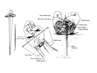 a- Las tumbas eran cavadas en la roca, como hoy día se puede comprobar en los alrededores de Jerusalén. Cuando el cuerpo se descomponía, se colocaban los huesos en una urna. Por eso, habitualmente había pequeñas habitaciones anexas que servían de osario. Y de esta manera varios sujetos de la misma familia podían ocupar la misma tumba. 