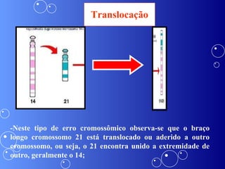 Translocação -Neste tipo de erro cromossômico observa-se que o braço longo cromossomo 21 está translocado ou aderido a outro cromossomo, ou seja, o 21 encontra unido a extremidade de outro, geralmente o 14; 