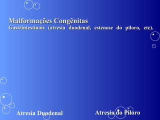 Malformações Congênitas Gastrintestinais (atresia duodenal, estenose do piloro, etc). Atresia Duodenal Atresia do Piloro 