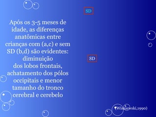 Após os 3-5 meses de idade, as diferenças anatômicas entre crianças com (a,c) e sem SD (b,d) são evidentes: diminuição dos lobos frontais, achatamento dos pólos occipitais e menor tamanho do tronco cerebral e cerebelo SD SD (Wisniewski,1990) 