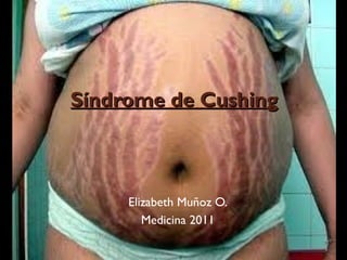 Síndrome de Cushing



     Elizabeth Muñoz O.
        Medicina 2011
 