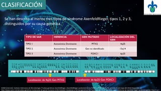 CLASIFICACIÓN
Se han descrito al menos tres tipos de síndrome AxenfeldRieger, tipos 1, 2 y 3,
distinguidos por su causa genética.
IVAMI [internet]. Instituto Valenciano de Microbiología. Pruebas genéticas AxenfeldRieger, (AxenfeldRieger syndrome) Genes FOXC1 y PITX2. [fecha de consulta 21 de mayo del 2016] Disponible en:
http://www.ivami.com/pruebas-geneticas-mutaciones-de-genes-humanos-enfermedades-neoplasias-y-farmacogenetica/1817-pruebas-geneticas-axenfeld-rieger-sindrome-de-axenfeld-rieger-syndrome-genes-i-foxc1-i-y-i-
 