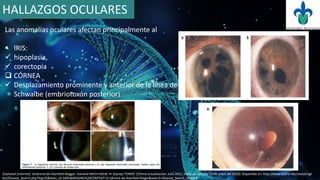 Las anomalías oculares afectan principalmente al
 IRIS:
 hipoplasia,
 corectopia
 CÓRNEA
 Desplazamiento prominente y anterior de la línea de
Schwalbe (embriotoxón posterior)
HALLAZGOS OCULARES
Orphanet [internet]. Sindrome de Axenfeld-Riegger. Daniella BACH-HOLM, Pr Zeynep TÜMER. [Última actualización: Julio 2011, fecha de consulta 21 de mayo del 2016]. Disponible en: http://www.orpha.net/consor/cgi-
bin/Disease_Search.php?lng=ES&data_id=3485&MISSING%20CONTENT=S-ndrome-de-Axenfeld-Rieger&search=Disease_Search_Simple#
 