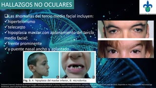 HALLAZGOS NO OCULARES
Las anomalías del tercio medio facial incluyen:
hipertelorismo
telecanto
hipoplasia maxilar con aplanamiento del tercio
medio facial,
frente prominente
y puente nasal ancho y aplastado.
Orphanet [internet]. Sindrome de Axenfeld-Riegger. Daniella BACH-HOLM, Pr Zeynep TÜMER. [Última actualización: Julio 2011, fecha de consulta 21 de mayo del 2016]. Disponible en: http://www.orpha.net/consor/cgi-
bin/Disease_Search.php?lng=ES&data_id=3485&MISSING%20CONTENT=S-ndrome-de-Axenfeld-Rieger&search=Disease_Search_Simple#
 