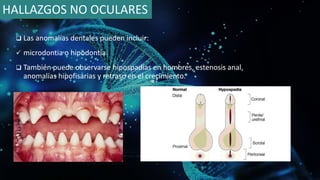  Las anomalías dentales pueden incluir:
 microdontia o hipodontia.
 También puede observarse hipospadias en hombres, estenosis anal,
anomalías hipofisarias y retraso en el crecimiento.
HALLAZGOS NO OCULARES
 