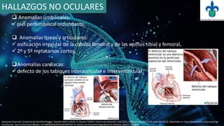 HALLAZGOS NO OCULARES
 Anomalías umbilicales:
 piel periumbilical redundante.
 Anomalías óseas y articulares:
 osificación irregular de la cabeza femoral y de las epífisis tibial y femoral,
 2º y 5º metatarsos cortos.
Anomalías cardiacas:
 defecto de los tabiques interauricular e interventricular.
Orphanet [internet]. Sindrome de Axenfeld-Riegger. Daniella BACH-HOLM, Pr Zeynep TÜMER. [Última actualización: Julio 2011, fecha de consulta 21 de mayo del 2016]. Disponible en: http://www.orpha.net/consor/cgi-
bin/Disease_Search.php?lng=ES&data_id=3485&MISSING%20CONTENT=S-ndrome-de-Axenfeld-Rieger&search=Disease_Search_Simple#
 