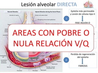 Lesión alveolar DIRECTA
Disminuye la producción
de surfactante
2
Epitelio más permeable
y Lesión de células tipo II
FASE AGUDA O
EXUDATIVA (0-7 días
1
Perdida de regeneración
del epitelio
FIBROSIS
4
Perdida de barrera
epitelial SEPSIS
3
AREAS CON POBRE O
NULA RELACIÓN V/Q
 