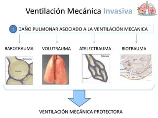 Ventilación Mecánica Invasiva
DAÑO PULMONAR ASOCIADO A LA VENTILACIÓN MECANICA
1
BAROTRAUMA VOLUTRAUMA ATELECTRAUMA BIOTRAUMA
VENTILACIÓN MECÁNICA PROTECTORA
 