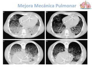 Mejora Mecánica Pulmonar
 Aumento de la rigidez de
la pared torácica
 No se afecta la rigidez
pulmonar o disminuye
 Reclutamiento
Efectos sobre la
PARED TORACICA
 El corazón reposa sobre
la pared torácica, la
compresión disminuye y
el pulmón puede ser
mejor ventilado
Efectos sobre el
CORAZON
 