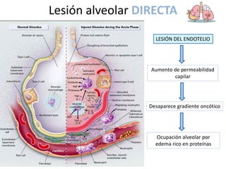 Lesión alveolar DIRECTA
Desaparece gradiente oncótico
Ocupación alveolar por
edema rico en proteínas
Aumento de permeabilidad
capilar
LESIÓN DEL ENDOTELIO
 