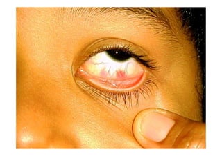 Síndrome, Febre, Icterícia e Hemorragia