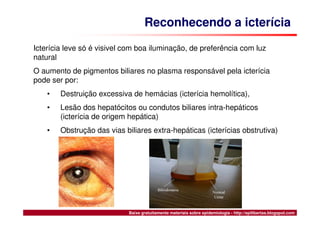 Síndrome, Febre, Icterícia e Hemorragia