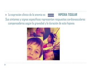 La expresión clínica de la anemia es
HIPOXIA TISULAR
Sus síntomas y signos específicos representan respuestas cardiovasculares
compensadoras según la gravedad y la duración de esta hipoxia.


 
