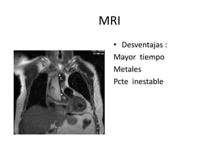 MRI
  • Desventajas :
  Mayor tiempo
  Metales
  Pcte inestable
 