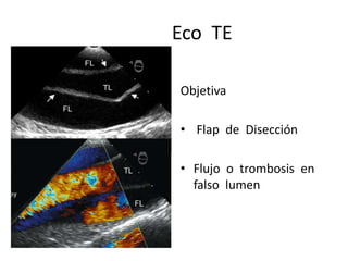Eco TE

Objetiva

• Flap de Disección

• Flujo o trombosis en
  falso lumen
 