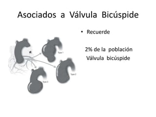 Asociados a Válvula Bicúspide
               • Recuerde

                2% de la población
                Válvula bicúspide
 