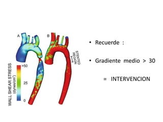 • Recuerde :

• Gradiente medio > 30

    = INTERVENCION
 