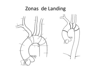 Zonas de Landing
 