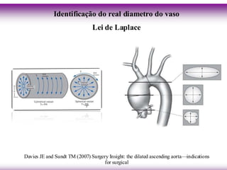 Identificação do real diametro do vaso
                               Lei de Laplace




Davies JE and Sundt TM (2007) Surgery Insight: the dilated ascending aorta—indications
                                    for surgical
 