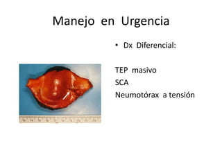 Manejo en Urgencia
         • Dx Diferencial:

         TEP masivo
         SCA
         Neumotórax a tensión
 